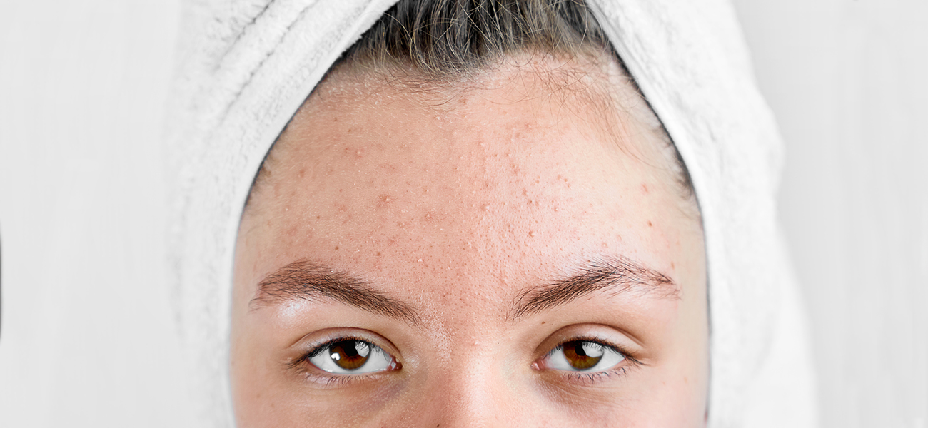 Are your hair products causing your acne? | Beauty Care Choices blog