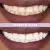 Elims Magic Melt-Away Teeth Whitening Masks